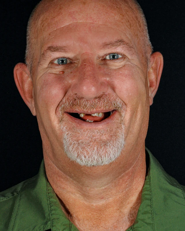 All-on-4 full mouth dental implant restoration success story in Playa del Carmen