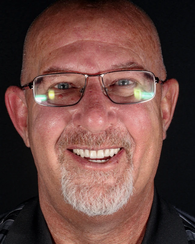 Before and after dental implant smile transformation All-on-4 Mexico clinic