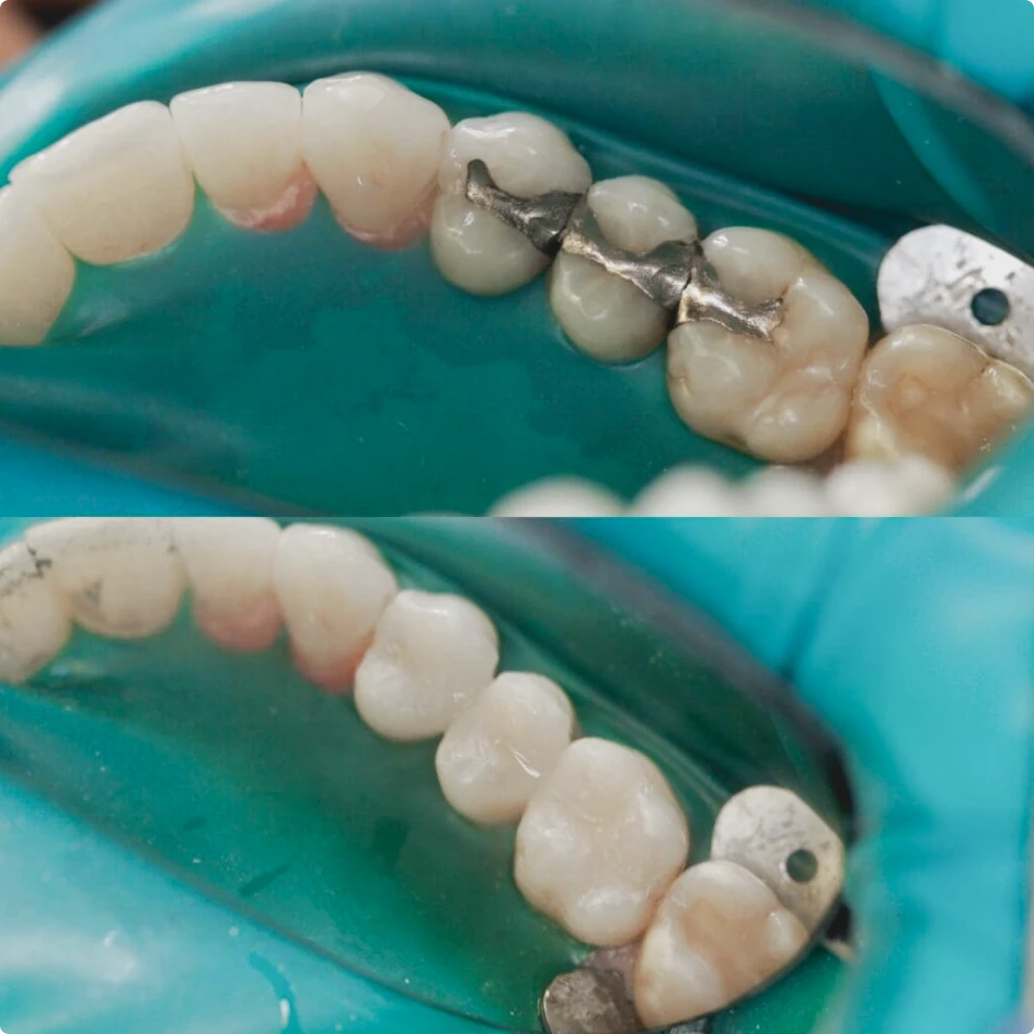 Before and after replacing metal fillings with white composite resin