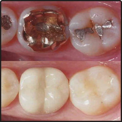 Safe silver mercury amalgam filling removal at Smile Makeover Playa del Carmen