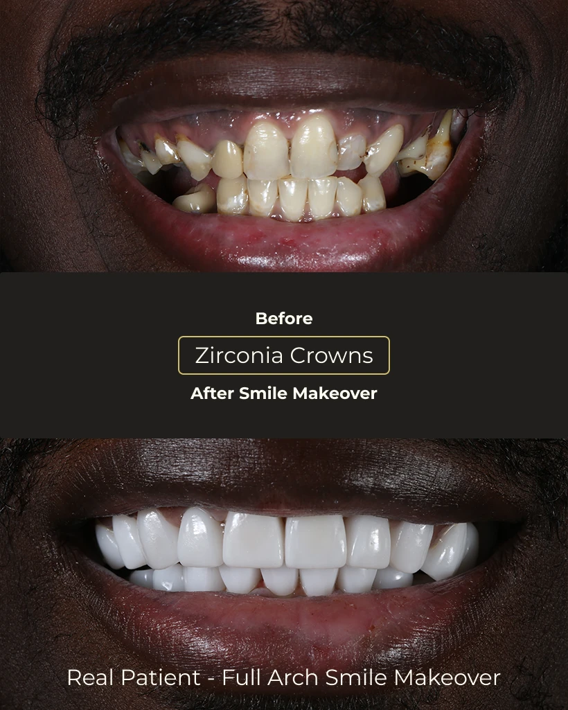 Smile Makeover Playa del Carmen cosmetic dentistry results