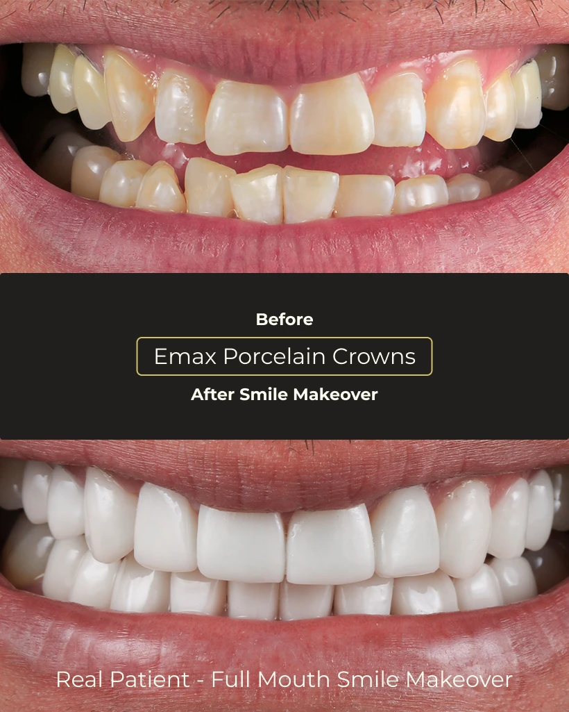Aesthetic dental crown results and patient feedback