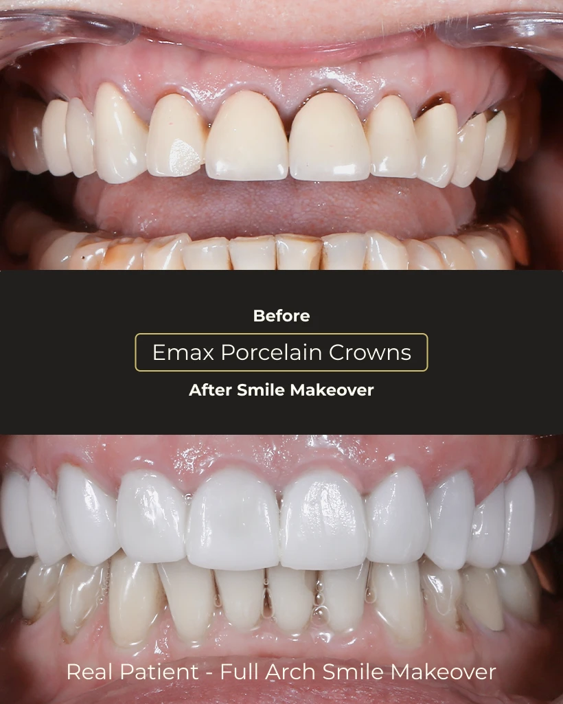 Final result of complete smile design treatment