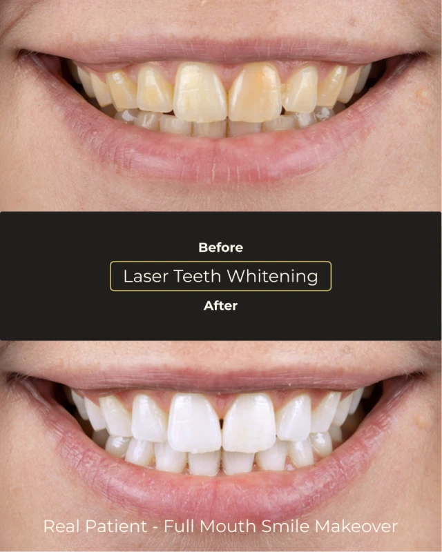 Before and after teeth whitening results at Smile Makeover Playa del Carmen