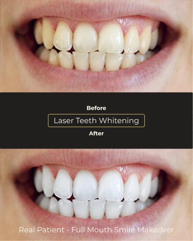Professional teeth whitening transformation by Smile Makeover Playa del Carmen dentist