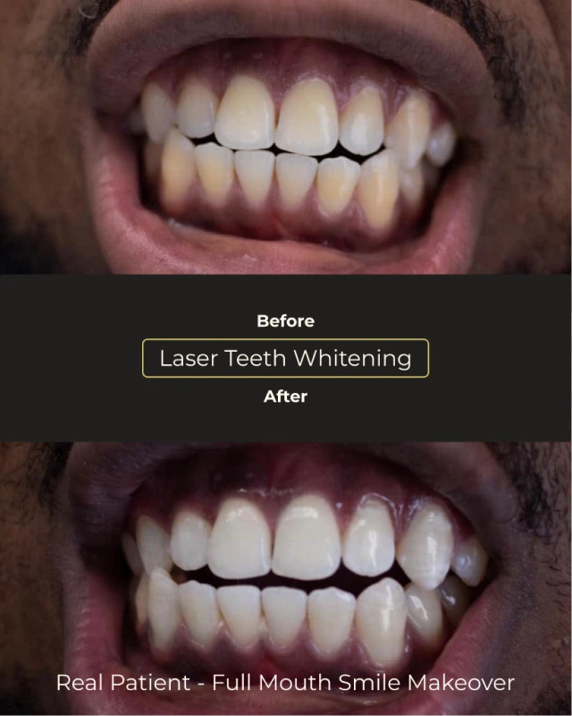 Cosmetic teeth whitening before and after performed in Playa del Carmen