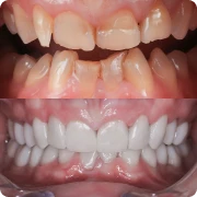 Before photo of Janet prior to complete smile makeover in Playa del Carmen