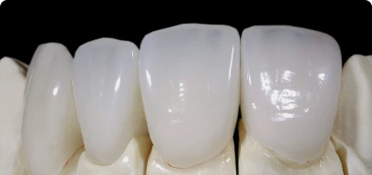 Premium dental crowns cost and materials info
