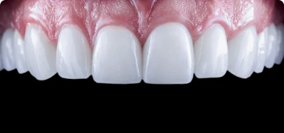 Porcelain and composite dental veneers cost options
