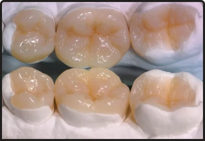 Aesthetic tooth-colored dental filling service in Playa del Carmen