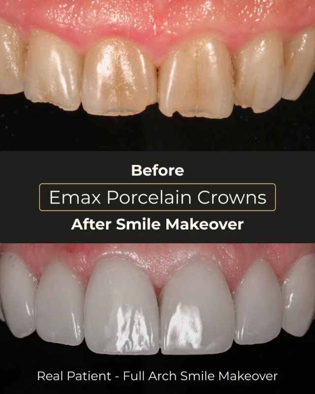 Functional and long-lasting dental bridge and crown results