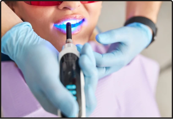 Laser teeth whitening treatment at Smile Makeover Playa del Carmen dental clinic