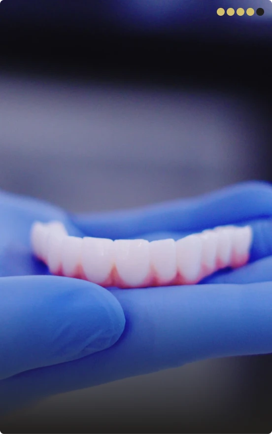 Step 4 restorative phase All-on-4 permanent denture placement Mexico