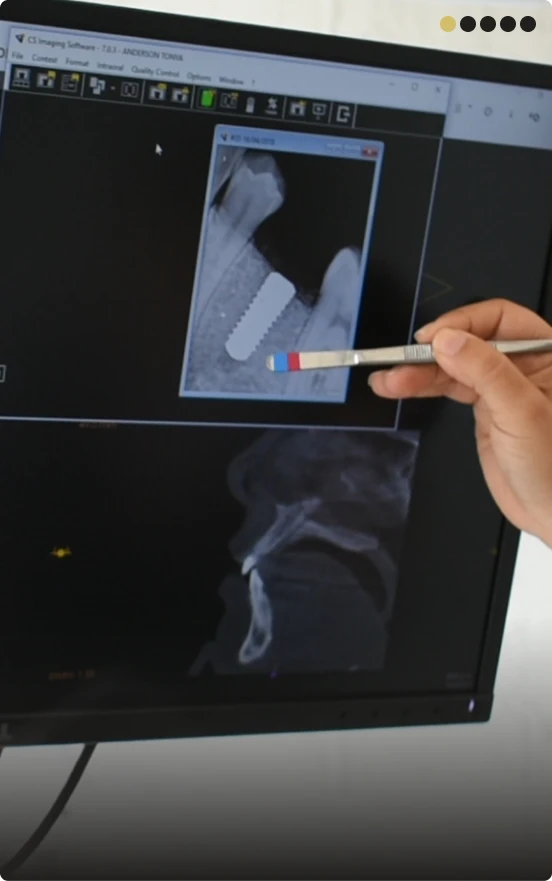 Implant placement consultation with specialist at Smile Makeover Playa del Carmen