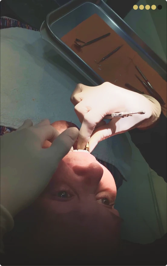 Post-surgery care and implant healing phase at Playa del Carmen dental clinic