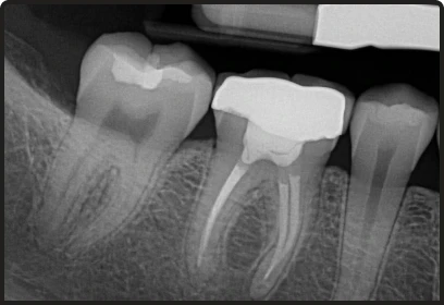 Placement of dental crown after root canal therapy to preserve natural tooth