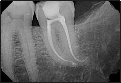 Endodontic retreatment procedure for previously infected teeth