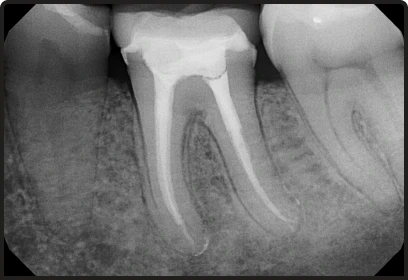 Painless root canal therapy using advanced rotary endodontics