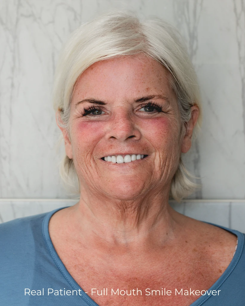 Full mouth rehabilitation patient satisfaction story