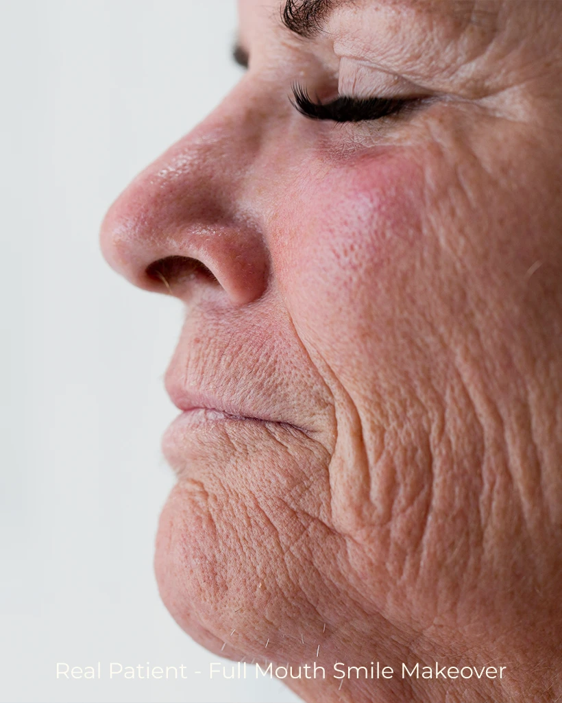 Functional and aesthetic restorative dental results