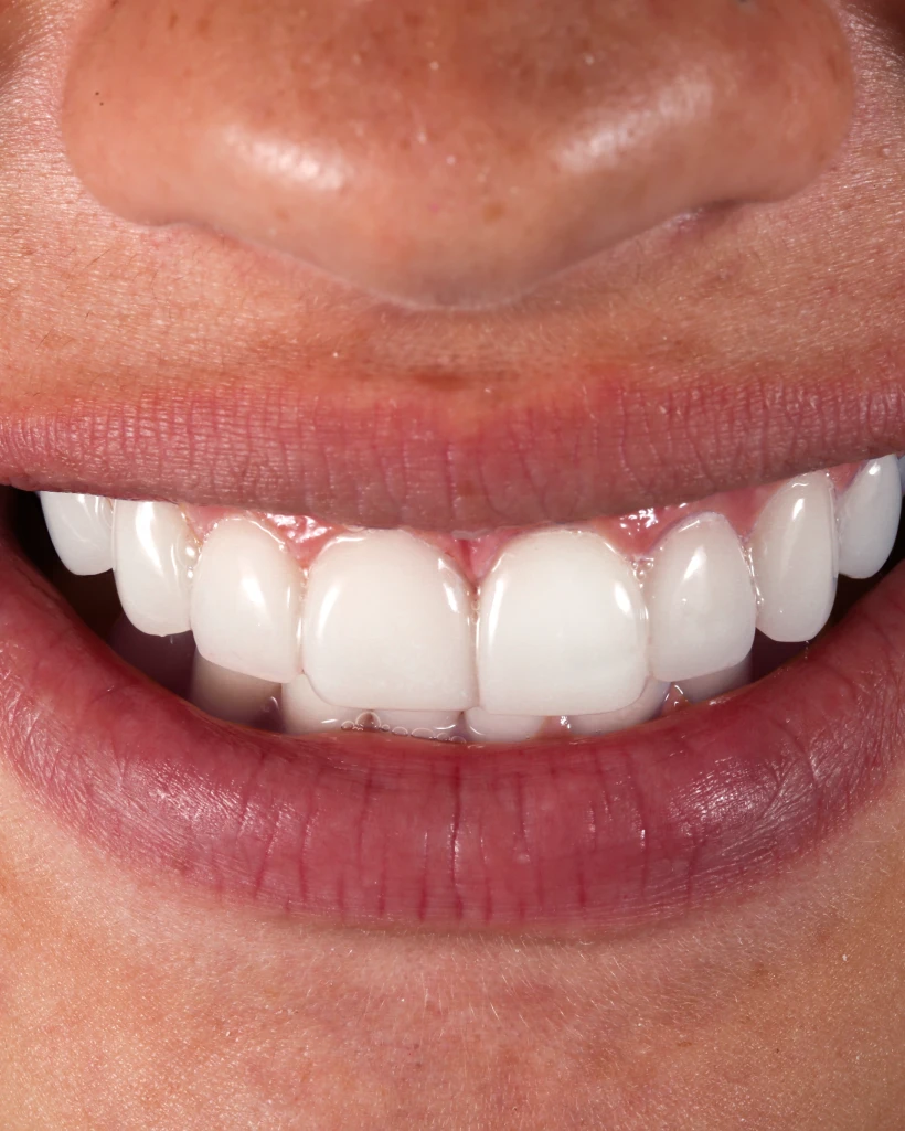 Beautiful patient smile after cosmetic dental treatment in Playa del Carmen