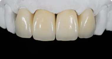Zirconia dental crowns option in Playa del Carmen Mexico