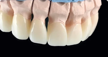 E-Max porcelain crowns cosmetic dentistry Mexico