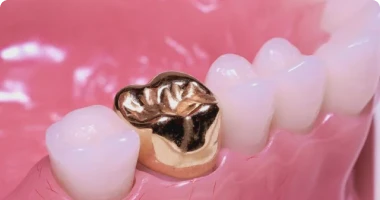 Gold dental crowns durable restorative option Mexico