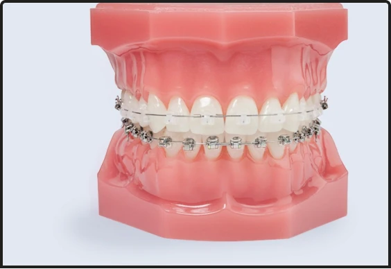 Clear ceramic dental braces for discreet orthodontic treatment