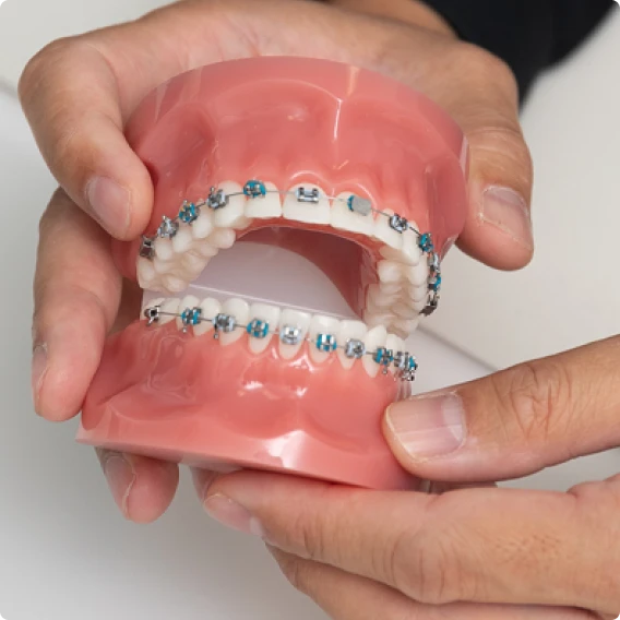 Orthodontic patient wearing dental braces at Smile Makeover clinic