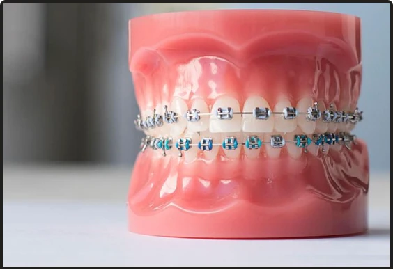 Traditional metal dental braces for complex orthodontic cases