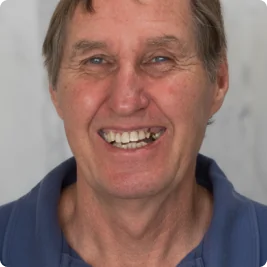 Close-up of a patient's teeth before treatment, showing missing teeth and significant wear.