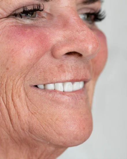Patient smiling after All-on-4 dental implant procedure at Smile Makeover Playa del Carmen