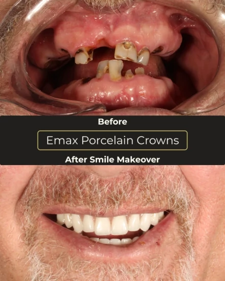 All-on-4 dental implants before and after full mouth restoration Playa del Carmen Mexico