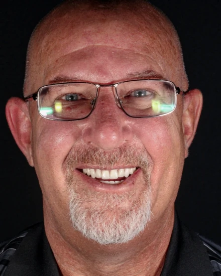 Before and after dental implant smile transformation All-on-4 Mexico clinic