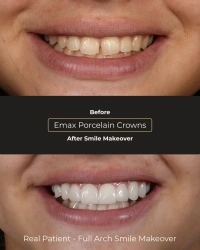 Before and after full arch smile makeover transformation
