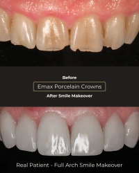 Porcelain veneers in Mexico before and after results