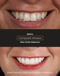 Complete smile rehabilitation comparison photos