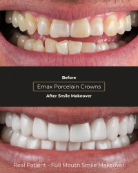 Composite veneers transformation before and after