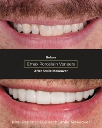 Digital smile preview vs final real-life results