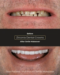 Restorative dentistry before and after for worn teeth