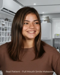 Cosmetic dentistry before and after for gap closure