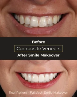 After cosmetic smile makeover at Smile Makeover Playa del Carmen with dental crowns and veneers