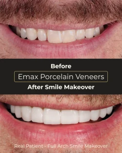 Before cosmetic dental treatment at Smile Makeover Playa del Carmen patient review case