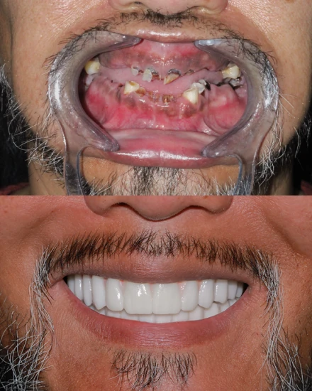 Side-by-side dental before and after comparison showing a full mouth restoration with dental implants.