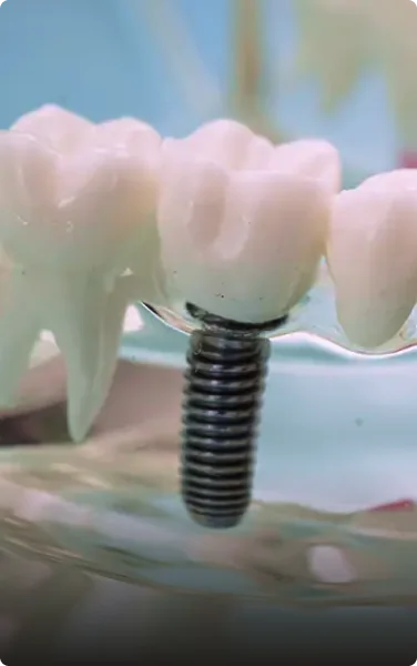 A dental implant fusing with the jawbone model, representing the osseointegration and healing period.