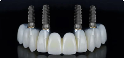 Dental implants pricing for restorative treatments