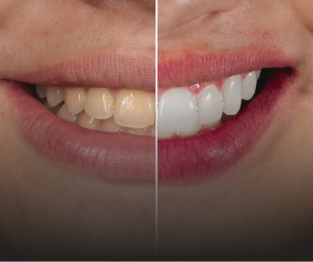 Side-by-side vertical 'before and after' comparison showing a restorative dental treatment result on missing and worn teeth.