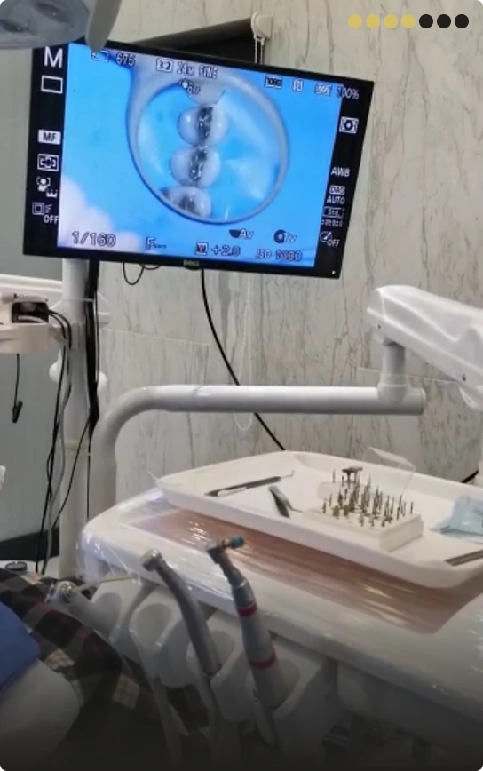 Step 4: High-volume suction and removal of filling debris