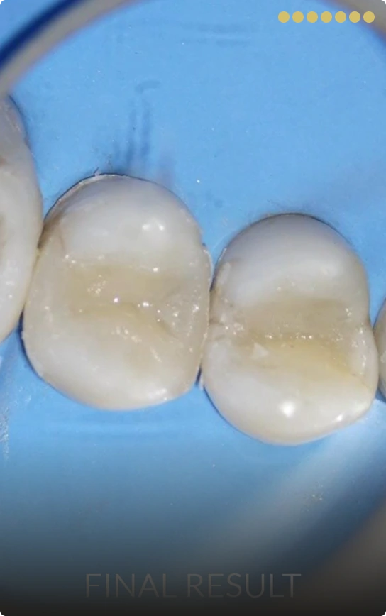 Step 7: Final polishing of the new metal-free dental filling